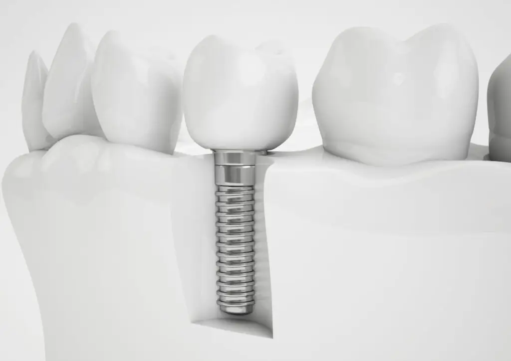 photo showing dental implant white