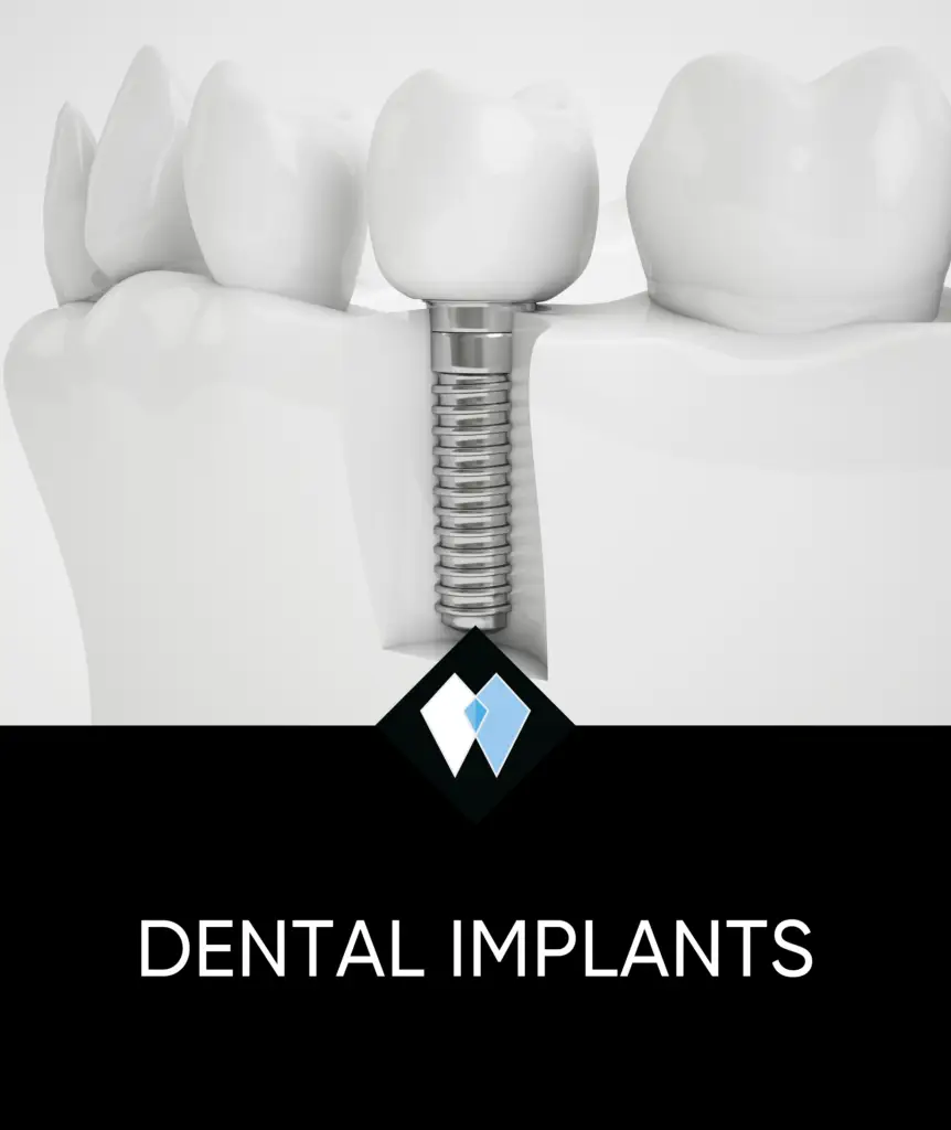 dental implants thumbnail