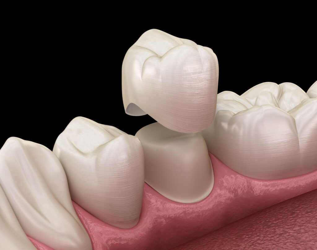 photo of a dental crown 3d render