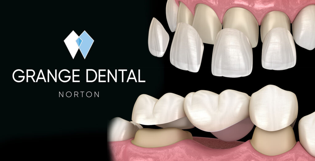 thumbnail for crown bridges and veneers