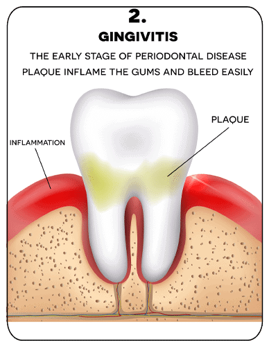 diagram showing the early stage of periodontal disease plaque inflame the gums and bleed easily