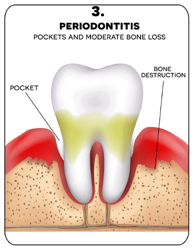 diagram showing Pockets and moderate bone loss