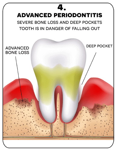 digram showing severe bone loss and deep pockets tooth is in danger of falling out