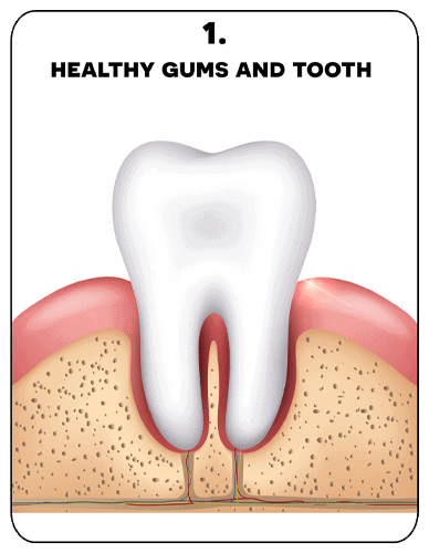 diagram showing healthy gums and tooth