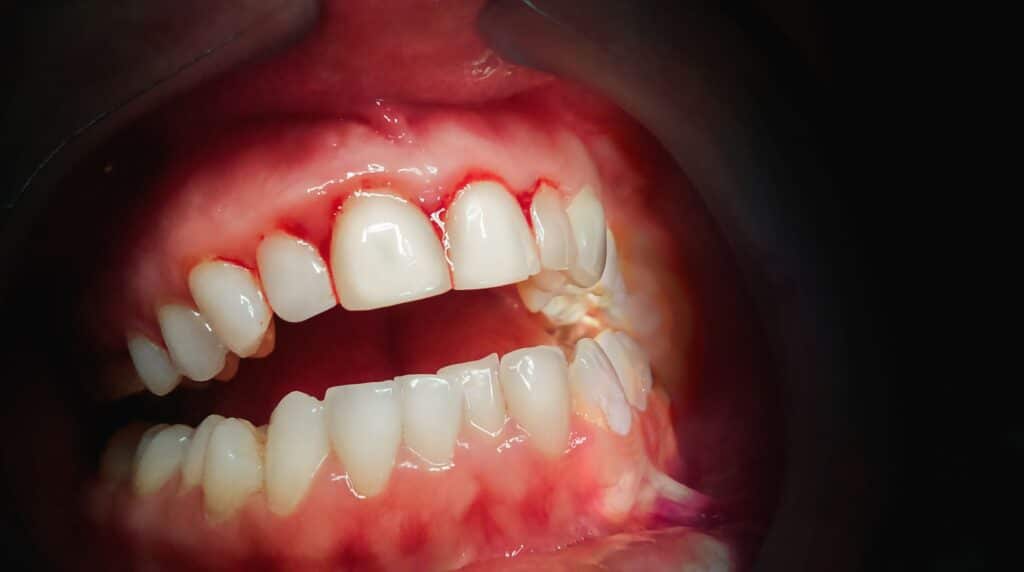 photo of bleeding gum